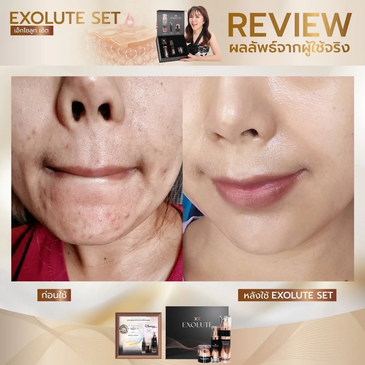 Exolute skin booster ultra ผิวกระจ่างใส บู๊สผิว ผิวเปล่งปลั่ง อ่อนเยาว์ Exolute complex multi serum ผิวชุ่มชื่น Exolute advance lifing filler cream ยกกระชับใบหน้า ลดริ้วรอย