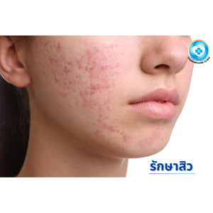 คลินิกรักษาสิว