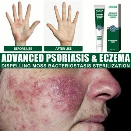 ครีมทาแก้ผื่นแผ้ ผื่นคัน สะเก็ดเงินADVANCED PSORIASIS & ECZEMA ครีมทาแก้ผื่นแผ้ ผื่นคัน สะเก็ดเงินADVANCED PSORIASIS & ECZEMA