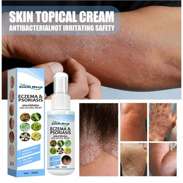 ECZEMA SPRAY สเปรย์รักษาโรคสะเก็ดเงิน ผื่นแพ้ ผื่นคัน ECZEMA SPRAY สเปรย์รักษาโรคสะเก็ดเงิน ผื่นแพ้ ผื่นคัน