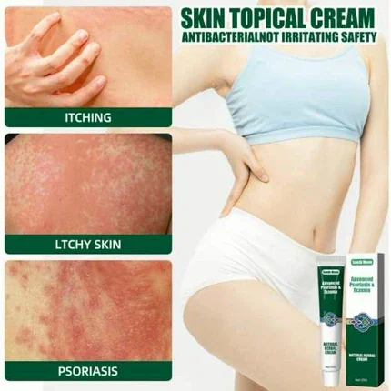 ครีมทาแก้ผื่นแผ้ ผื่นคัน สะเก็ดเงินADVANCED PSORIASIS & ECZEMA image 2 ครีมทาแก้ผื่นแผ้ ผื่นคัน สะเก็ดเงินADVANCED PSORIASIS & ECZEMA image 2