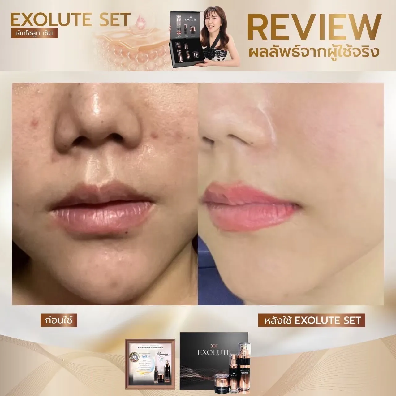 Exolute skin booster ultra ผิวกระจ่างใส บู๊สผิว ผิวเปล่งปลั่ง อ่อนเยาว์ Exolute complex multi serum ผิวชุ่มชื่น Exolute advance lifing filler cream ยกกระชับใบหน้า ลดริ้วรอย